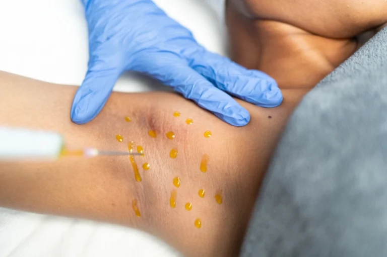 Body chemical peel - Skin Reveal Aesthetics, Nairobi Kenya